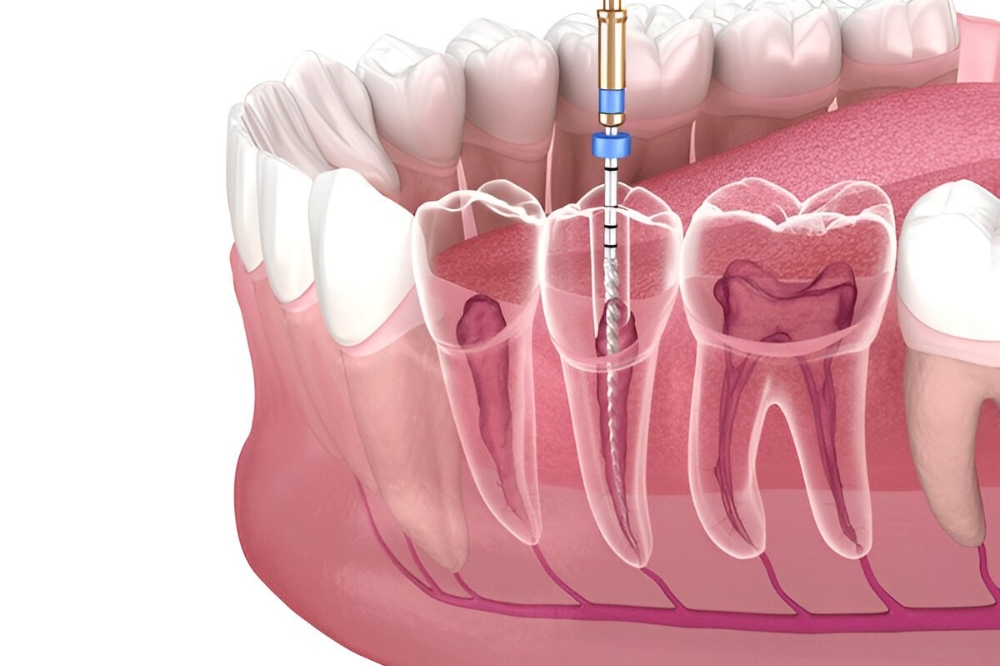 Dentist performing root canal to save natural tooth